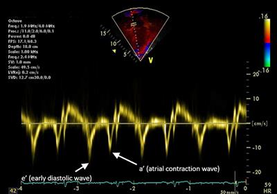 Cardiac and Vascular Target Organ Damage in Pediatric Hypertension